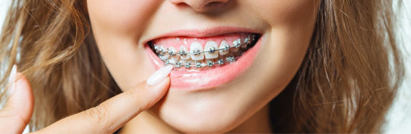 What Is The Best Dental Guard For Braces? - WatchMyMouth